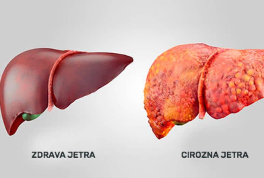 zdrava i masna jetra